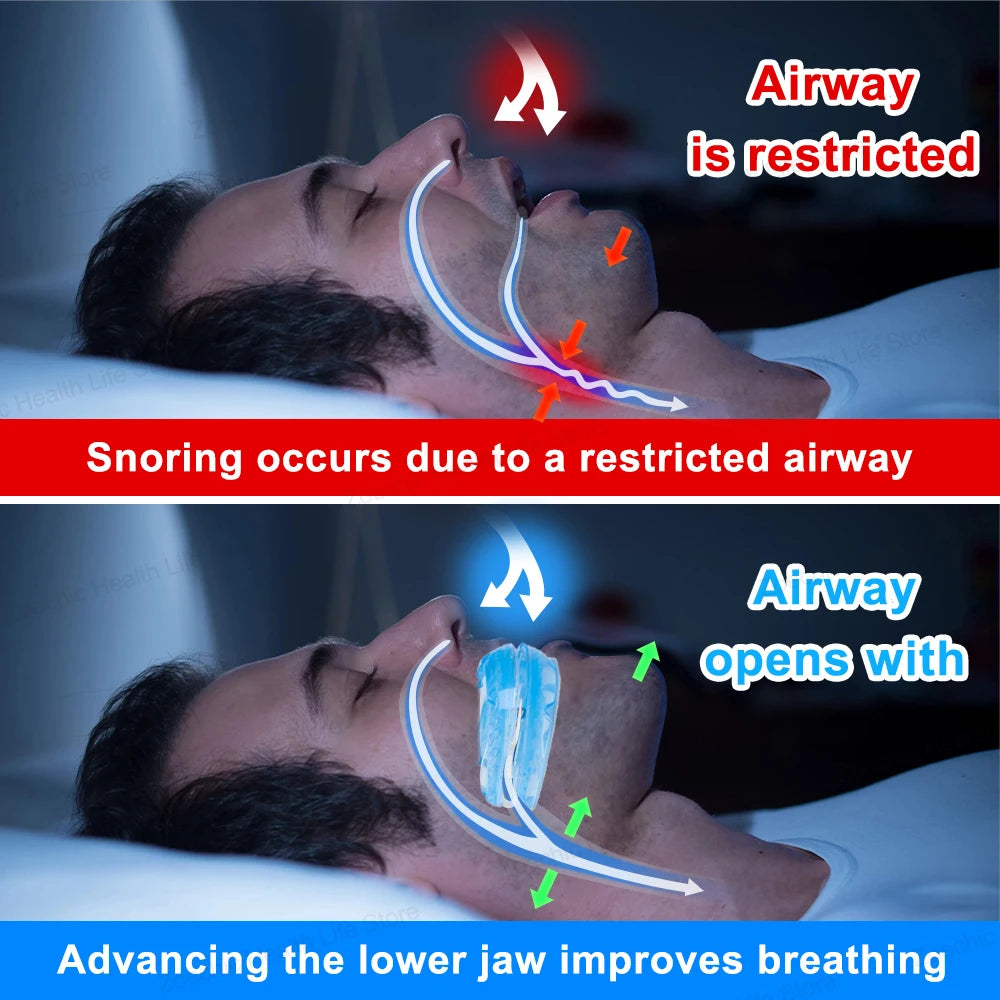 Deep in Health™ Adjustable Anti Snoring Mouth Guard